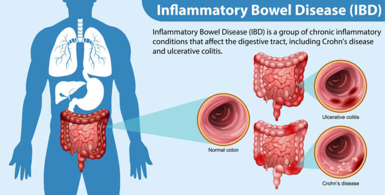 Inflammatory Bowel Disease Treatment Near Me