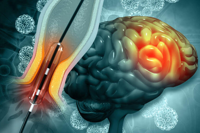 3d illustration of Balloon angioplasty procedure with stent in vein to explain Interventional Cardiology.